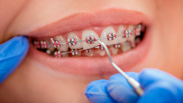 Лигатурные брекеты