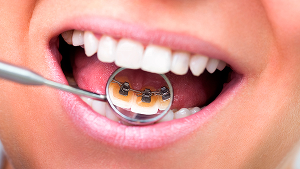 Лингвальные брекеты