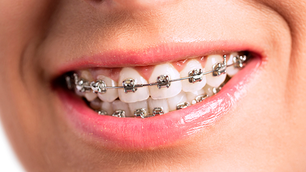 Вестибулярные брекеты