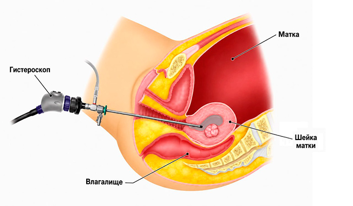 Как проводится гистерорезектоскопия миомы и полипов