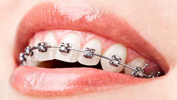 Безлигатурные брекеты